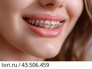 Close-up portrait of a smiling woman with orthodontic braces. Стоковое AI-изображение, AI-художник Katsiaryna Repich / Фотобанк Лори