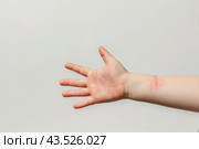 Рука с атопическим дерматитом, псориаз. Стоковое AI-изображение, AI-художник Терехова Марина / Фотобанк Лори