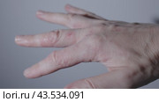 Dry hand with redness from eczema in close-up. Dermatology eczema on palm hand noting severity condition skin Eczema diagnosing skin disorder recommending treatment Eczema on dry skin redness. Стоковое видео, видеограф Olesia Kondrateva / Фотобанк Лори