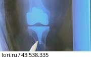 X-ray of the endoprosthesis knee joint after surgery. Стоковое видео, видеограф Ирина Старикова / Фотобанк Лори