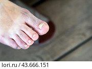 A damaged toenail after a fungal disease. Стоковое фото, фотограф Татьяна Степанищева / Фотобанк Лори
