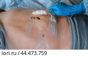 Hands of medic or nurse in blue gloves examining a fresh suture on a male stomach after laparoscopy surgical removal of appendicitis. Doctor examines of the patient. Man belly with medical stitches. Стоковое видео, видеограф Марина Демидюк / Фотобанк Лори