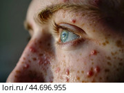 Young person with freckles and acne looking away from the camera. Стоковое AI-изображение, AI-художник Иван Рябоконь / Фотобанк Лори