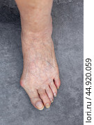 An old woman's foot with untrimmed nails and a painful, enlarged big toe joint. Стоковое фото, фотограф Коханова Наталья / Фотобанк Лори