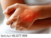 Inflamed skin on hand with psoriasis vulgaris, eczema and other skin conditions. Стоковое AI-изображение, AI-художник Станислав Тарко / Фотобанк Лори
