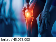 Knee pain, joint inflammation, arthritis and degenerative changes, woman suffering from leg ache and doing self-massage. Стоковое AI-изображение, AI-художник Станислав Тарко / Фотобанк Лори