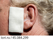 Ear diseases. Dropping hydrogen peroxide into a man's ears to soften earwax. Ear with solution bubbles, close-up. Стоковое фото, фотограф Коханова Наталья / Фотобанк Лори