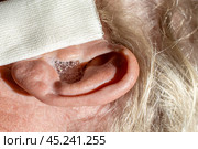 Ear diseases. Dropping hydrogen peroxide into a man's ears to soften earwax. Ear with solution bubbles, close-up. Стоковое фото, фотограф Коханова Наталья / Фотобанк Лори