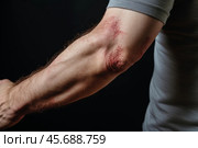 Man showing severe eczema rash on arm and elbow. Стоковое AI-изображение, AI-художник Иван Рябоконь / Фотобанк Лори