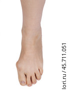 Leg with deformed joint. Стоковое фото, фотограф Дмитрий Киселёв / Фотобанк Лори