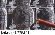 MRI lumbar spine background, magnetic resonance tomography. Doctor examines MRI of lumbar spine with pinched discs of spine and nerves. Стоковое видео, видеограф Андрей Армягов / Фотобанк Лори