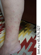 Кожа с высыпанием на ноге. Псориаз. Skin rash on the leg. Psoriasis. Стоковое фото, фотограф Юрий Пуликов / Фотобанк Лори
