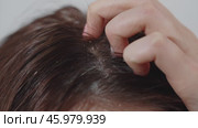 Young woman scratching her scalp, showing dandruff and irritated skin. Стоковое видео, видеограф Илья Шаматура / Фотобанк Лори
