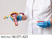Doctor or nurse holding Uterus and Ovaries model with pathology and gynecological speculum. Ovarian and Cervical cancer, Cervix disorder, Endometriosis, Hysterectomy, Uterine fibroids. Стоковое фото, фотограф Ирина Михайличенко / Фотобанк Лори