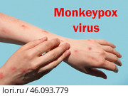 Phrase MONKEYPOX VIRUS on blue background and Patient with Monkey Pox. Monkeypox new disease dangerous over the world. Painful rash, red spots blisters. Close up human hands with Health problem. Стоковое фото, фотограф Марина Демидюк / Фотобанк Лори