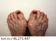 Подногтевая гематома через 6 месяцев после травмы ноги тесной обувью. Skier’s Toe is characterised by bleeding under the nail bed. The medical term for a Skier’s Toe is a Subungual Haematoma. Subungual hematoma 6 months after a leg injury from tight shoes. The effect of wearing uncomfortable shoes. Pedicure and podiatry. Medicine concept foot isolated on white. Стоковое фото, фотограф Iva Noel / Фотобанк Лори