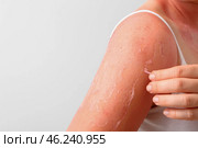 Woman with red sunburned skin against light background, closeup. Стоковое фото, фотограф Pixel_shot / Фотобанк Лори