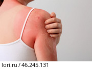 Woman with red sunburned skin against light background, closeup. Стоковое фото, фотограф Pixel_shot / Фотобанк Лори