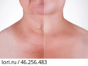 Skin rejuvenation on the neck, before after anti aging concept, wrinkle treatment, facelift and plastic surgery. Стоковое фото, фотограф Станислав Тарко / Фотобанк Лори