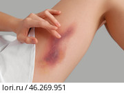 Young woman with bruised leg on grey background, closeup. Стоковое фото, фотограф Pixel_shot / Фотобанк Лори
