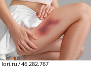Young woman with bruised leg on grey background, closeup. Стоковое фото, фотограф Pixel_shot / Фотобанк Лори