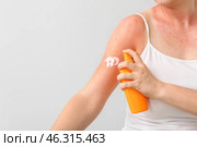 Woman with red sunburned skin applying cream against light background, closeup. Стоковое фото, фотограф Pixel_shot / Фотобанк Лори