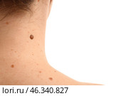 Young woman with moles on white background, closeup. Стоковое фото, фотограф Pixel_shot / Фотобанк Лори