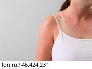 Woman with red sunburned skin against light background, closeup. Стоковое фото, фотограф Pixel_shot / Фотобанк Лори