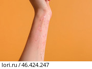 Woman with red sunburned skin against color background. Стоковое фото, фотограф Pixel_shot / Фотобанк Лори