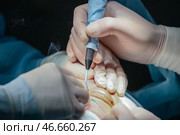 Проведение пластической операции на лице пациента. Стоковое фото, фотограф Сергей Булкин/NEWS.ru / ТАСС / Фотобанк Лори