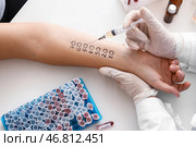 Молодая женщина проходит процедуру кожных проб аллергена в клинике. Стоковое фото, фотограф Pixel_shot / Фотобанк Лори