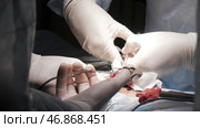 Close up of surgeons removing the tumor from the testicle of a man patient, cancer and medicine concept. Стоковое фото, фотограф David Kashakhi / Фотобанк Лори