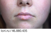 Concept of medicine and immunology, unhappy female face with red spots on her lips. Стоковое фото, фотограф David Kashakhi / Фотобанк Лори