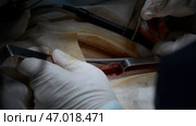 Close up of process of the real surgery at the hospital. Стоковое фото, фотограф David Kashakhi / Фотобанк Лори