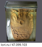 April 1, 2023. Belarus, Minsk. Exhibition of anatomical exhibits. The stomach organ of a person with a perforated ulcer is an anatomical exhibit preserved in alcohol in a formaldehyde solution. Редакционное фото, фотограф Лазаренко Светлана / Фотобанк Лори