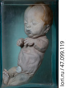 April 1, 2023. Belarus, Minsk. Exhibition of anatomical exhibits. Human infant with pathological development of microcephaly. Human dwarf. Achondroplasia. Редакционное фото, фотограф Лазаренко Светлана / Фотобанк Лори