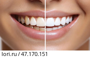 Transformation of a patient's smile shown in detailed before-and-after comparison of dental treatment results. Визуальное сравнение демонстрирует улыбку пациента до и после стоматологического лечения, подчеркивая значительные улучшения в яркости и выравнивании зубов. Стоковое AI-изображение, AI-художник Katsiaryna Repich / Фотобанк Лори