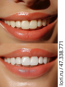 Before and after comparison of teeth whitening results in a close-up view. Сравнение результатов отбеливания зубов до и после на крупном плане. Стоковое AI-изображение, AI-художник Katsiaryna Repich / Фотобанк Лори
