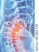 Medically accurate 3d illustration showing cervical spine pain. Стоковое AI-изображение, AI-художник Юрий Поздников / Фотобанк Лори