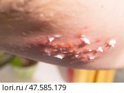 Woman with shingles on the skin she feels very painful. Стоковое фото, фотограф Anastasia Kayander / Фотобанк Лори