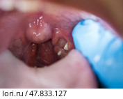Tonsillitis, inflammation of the tonsils, sore throat and neck pain. Стоковое фото, фотограф Станислав Тарко / Фотобанк Лори