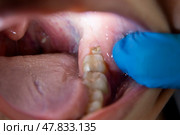Impacted wisdom tooth with gum hood, jaw inflammation, teeth extraction, dentistry concept. Стоковое фото, фотограф Станислав Тарко / Фотобанк Лори
