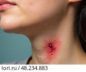 Woman Showing Red Scar on Neck Following Thyroid Surgery, Gazing at the Camera; Healthcare, Surgery Centers, Cosmetic Clinics. Стоковое AI-изображение, AI-художник Sergey Grishin / Фотобанк Лори