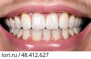 resin white dental fillings ai generated. Стоковое AI-изображение, AI-художник Vectorwin / Фотобанк Лори