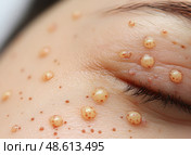 A person exhibits multiple small cysts on an eyelid, indicating a possible skin condition requiring medical attention for health management. Стоковое AI-изображение, AI-художник Данила Большаков / Фотобанк Лори