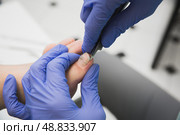 Профессиональный педикюр с использованием корректирующей скобы. Врач-подолог лечит вросший ноготь пациента, обрезает лишнее щипчиками. Стоковое фото, фотограф Катерина Бондарец / Фотобанк Лори