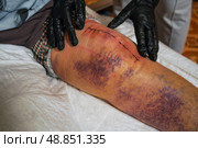 Doctor checking elderly woman patient with scar knee replacement endoprosthetics surgery. Стоковое фото, фотограф Ирина Старикова / Фотобанк Лори