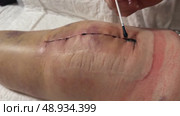 Medical sutures, stitch after surgery, stitched surgical sutures on human body smeared betadine. Medical surgical care. Close-up. Стоковое видео, видеограф Ирина Старикова / Фотобанк Лори