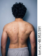 Man with mosquito bites on his back. Стоковое фото, агентство Ingram Publishing / Фотобанк Лори