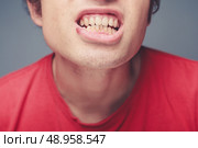 Young man with a cold sore on his lip and plaque on his teeth. Стоковое фото, агентство Ingram Publishing / Фотобанк Лори